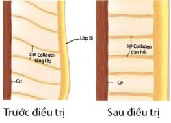 Trẻ đẹp như tuổi 20 sau 4 tuần chăm sóc