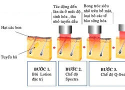 Trẻ hóa da dày sừng với Laser Spectra