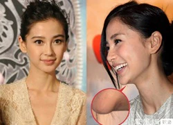 Angelababy lộ cằm &#8220;thừa thịt&#8221; phồng rộp bất thường