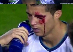 Điểm lại những lần đổ máu vì chấn thương của Ronaldo