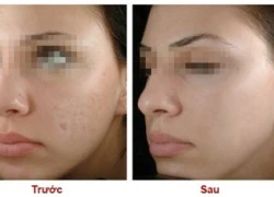 Trị sẹo lõm bằng công nghệ Thermage