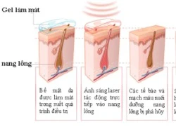 Triệt lông vĩnh viễn với công nghệ mới Xlaser