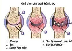 Bí quyết ăn uống phòng ngừa thoái hóa khớp