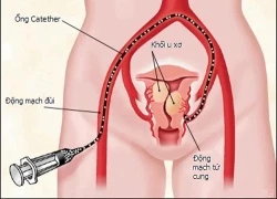 Lý do chị em dễ bị u xơ tử cung