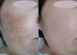 PRP và Melasma Peel tìm lại làn da không tuổi