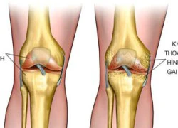 MedicaMego: Đột phá trong điều trị đau mỏi khớp