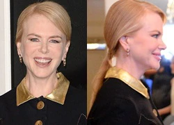 Nicole Kidman lộ mặt biến dạng vì botox