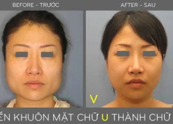 Phẫu thuật khuôn mặt chữ U thành V