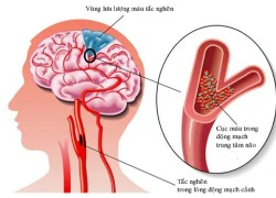 ề phòng rối loạn tuần hoàn não