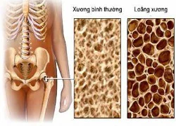 Hiểu đúng để phòng ngừa bệnh xốp xương