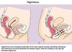 Mắc kẹt khi &#8220;yêu&#8221;, lời đồn hay sự thật?