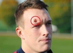 Phil Jones "khoe" vết rách kinh hoàng trên trán