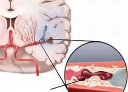 Phòng & điều trị thiếu mãu não