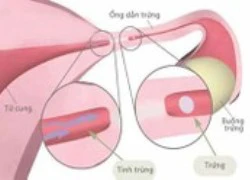 3 dấu hiệu chính nhận biết nguy cơ tắc vòi trứng ở chị em