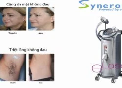 Căng da mặt không đau bằng laser