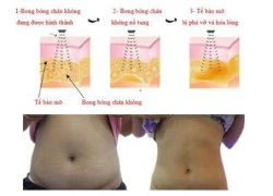 Đẩy bật mỡ thừa không cần phẫu thuật