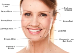 Hiểu đúng về lợi ích của botox khi làm đẹp