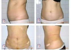 Hút mỡ bụng bằng Laser CoolLipo