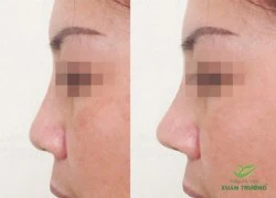 Nâng mũi không phẫu thuật bằng phương pháp filler