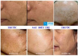 Thanh tẩy nám bằng ánh sáng Dual Toning