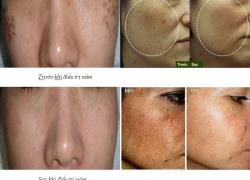 Trị nám da bằng công nghệ Spectra Laser