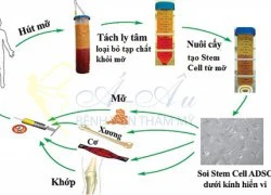 Xóa tan nỗi lo nâng ngực bằng túi