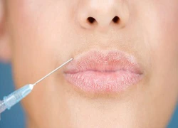 Biến dạng môi vì tiêm botox