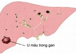 Hiểu đúng về bệnh u máu trong gan