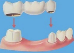 'Bỏng miệng' sau khi làm răng giả