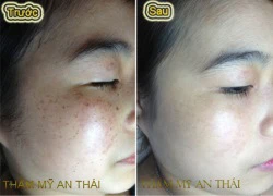 Cách trị tàn nhang tận gốc