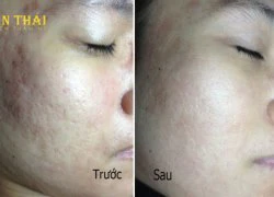 Công nghệ 5D được yêu thích trong trị sẹo lõm