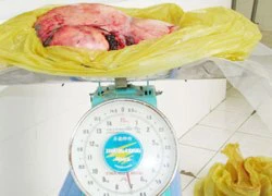 Khối u 7 kg trong bụng cụ bà 78 tuổi