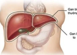 Những dấu hiệu chứng tỏ bạn bị tổn thương gan