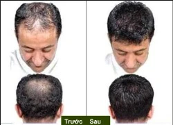 Rụng tóc - giải pháp điều trị