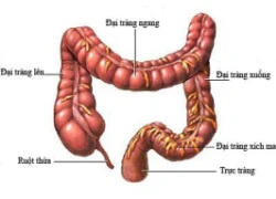 Thực phẩm kiêng kị với người viêm loét đại tràng