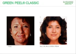 Ưu đãi 20% khi trị nám với Green Peel