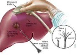 Việt Nam điều trị thành công ung thư gan bằng hạt vi cầu phóng xạ