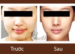 Bạn có muốn sở hữu cằm đẹp như sao Hàn