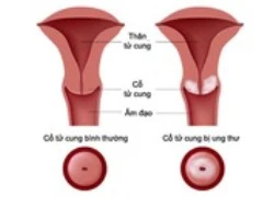 Cách tốt nhất để phòng ngừa ung thư cổ tử cung hiệu quả