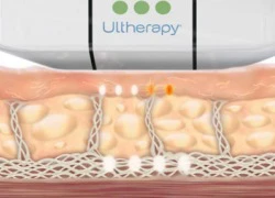 Căng da mặt không phẫu thuật với Ultherapy