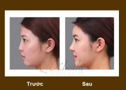 Nâng mũi đúng tiêu chuẩn Hàn Quốc