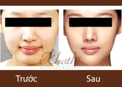 Phẫu thuật cằm đẹp như Sao