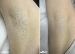 Phương pháp tẩy lông bằng tia laser