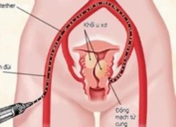 Bí quyết phòng ngừa bệnh u xơ tử cung cho phụ nữ trẻ