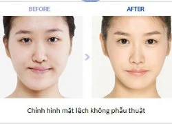 Gọt hàm có chỉnh được mặt lệch?