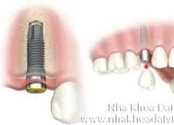 Implant &#8211; giải pháp trồng răng lý tưởng