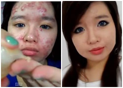 Mặt mụn lồi lõm thành mịn màng nhờ make-up