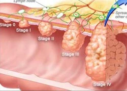 Một số bệnh ung thư phổ biến và những điều không thể bỏ qua