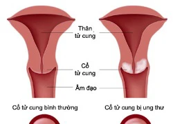 Một vài triệu chứng nhận biết ung thư cổ tử cung