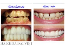 Thay đổi răng xấu nhờ công nghệ răng sứ mới.